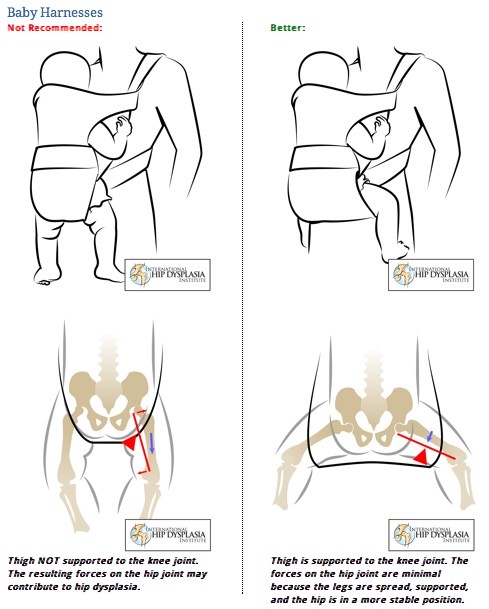 Position physiologique selon l'institut international de la dysplasie de la hanche